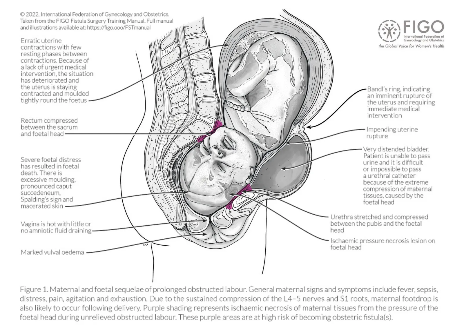 International Day to End Obstetric Fistula